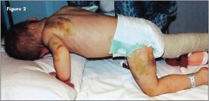 Bruises Missed Malpractice Child Abuse